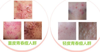 不同程度青春痘症状表现